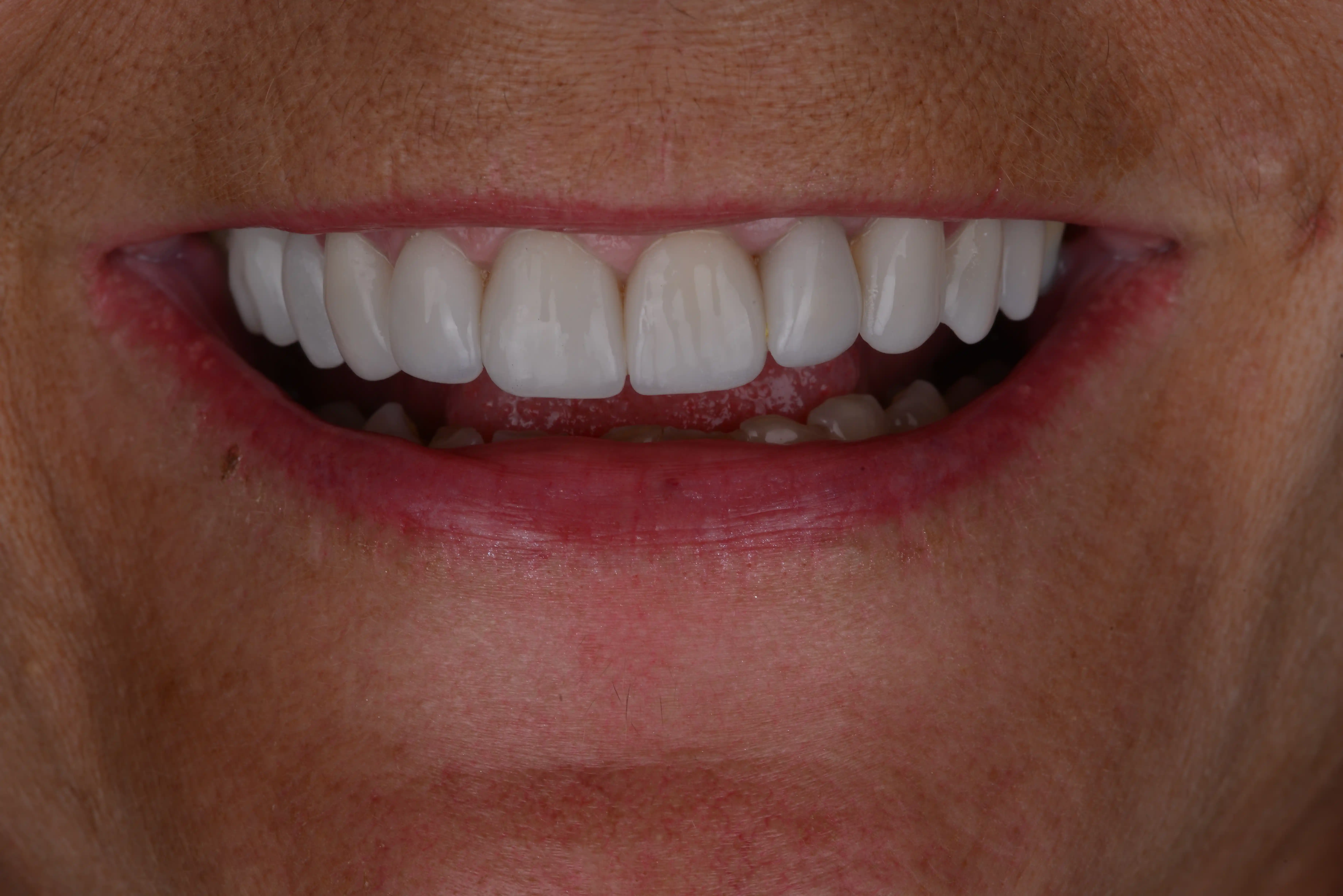 Hollywood Smile - After