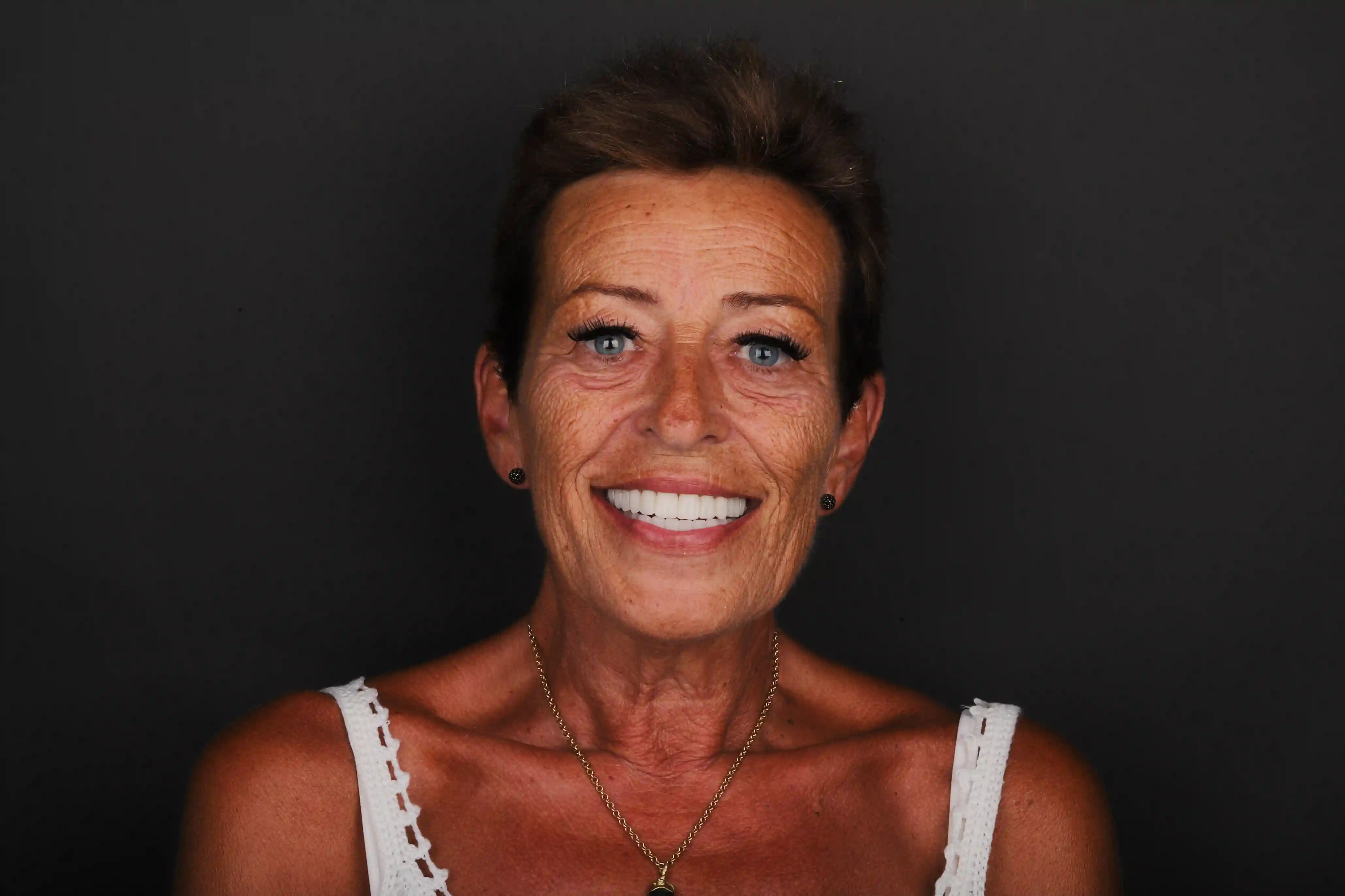 Dental Implants - After